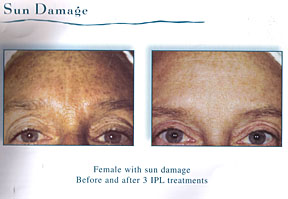 Chicago Laser Wrinkle Reduction